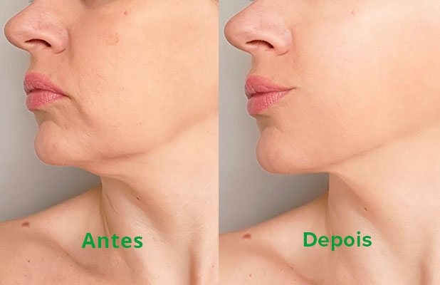 Tratamento para Papada com Aplicação de Enzimas + Criofrequência:  BioMedical Clínica de Estética Londrina - Cidade Oferta